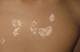 患白癜风饮食上要注意哪些 患白癜风饮食上要注意哪些.jpg