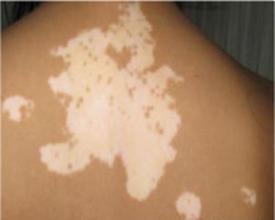 饮食上白癜风患者有什么要注意的 饮食上白癜风患者有什么要注意的.jpg