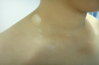 从颜色上怎么区分白癜风呢 从颜色上怎么区分白癜风呢.jpg